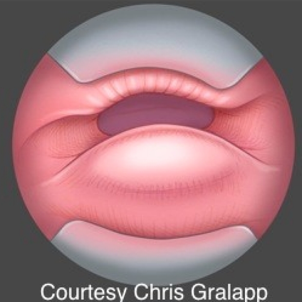 Illustration of a cricopharyngeus bar and the entrance to the esophagus.